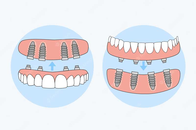 teeth screws braces