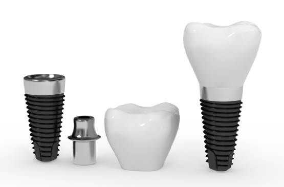 Dental implants