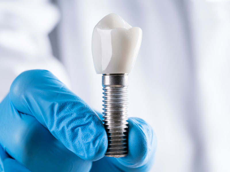 Featured image for “Dental Implants – Are They Right for You?”