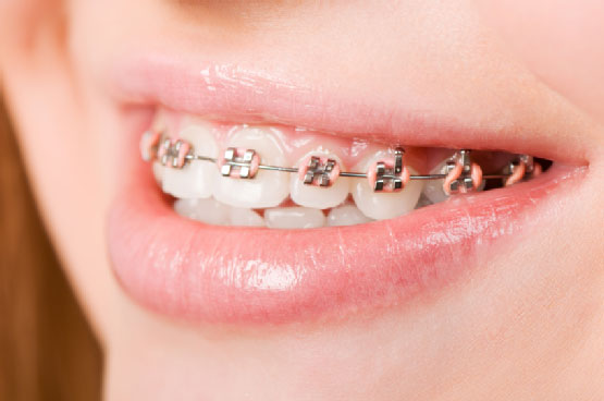 dental braces