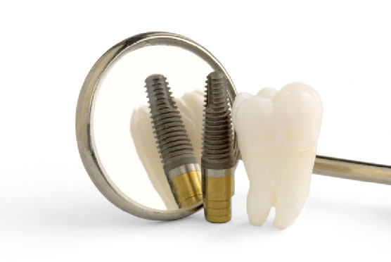 Dental implants