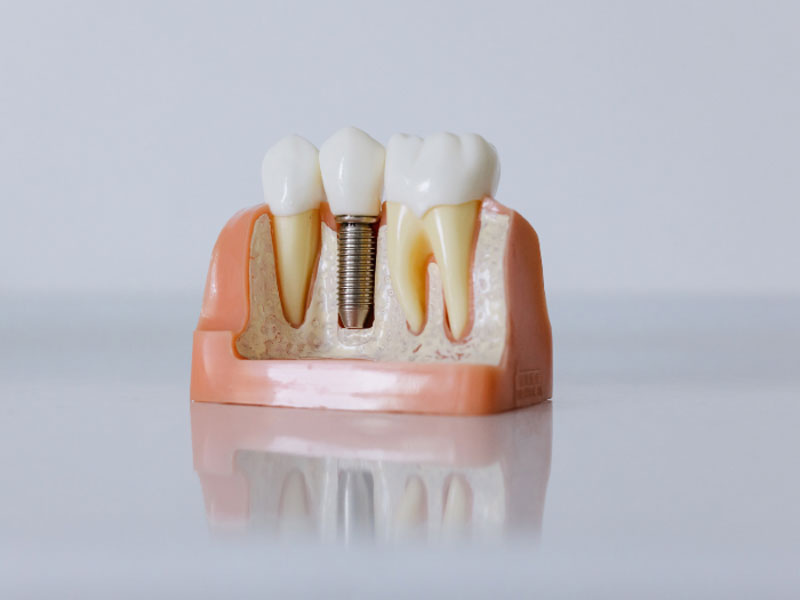 Teeth implants