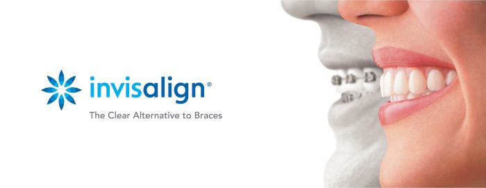 Featured image for “Invisalign: The Clear Alternative to Braces”