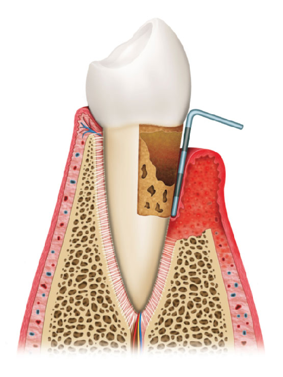 affected tooth