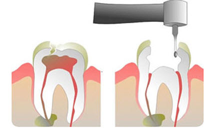 Root Canal Therapy