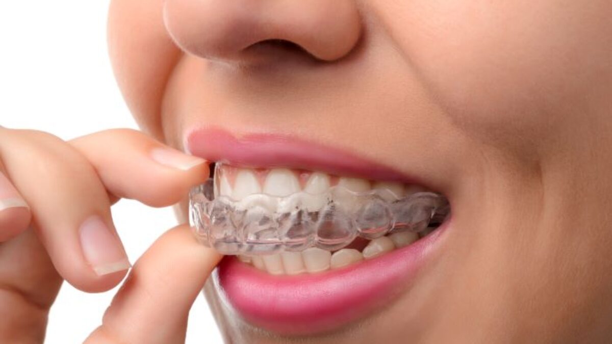Why-Adult-Orthodontic-
