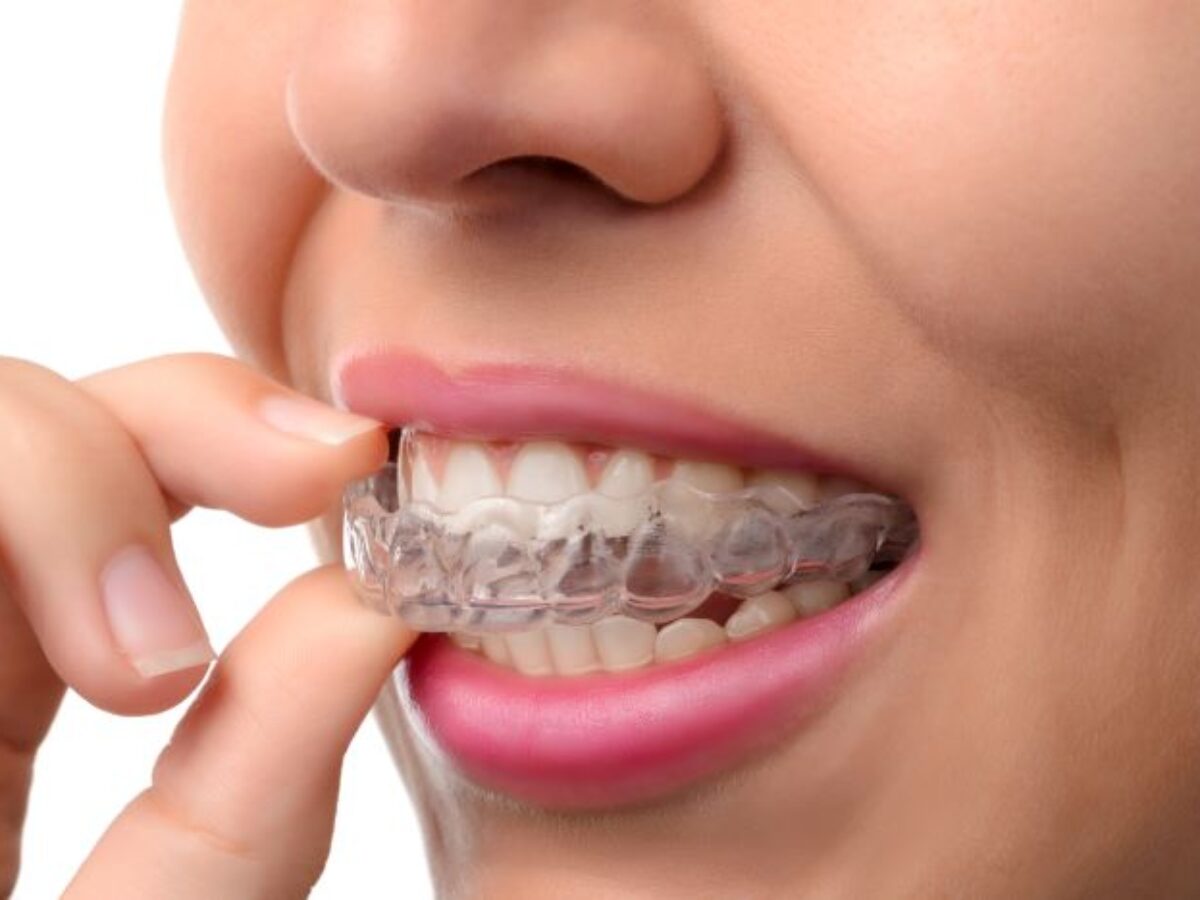 Why-Adult-Orthodontic-