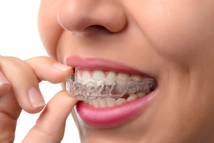 Featured image for “Why Adult Orthodontic Treatment Makes Sense”