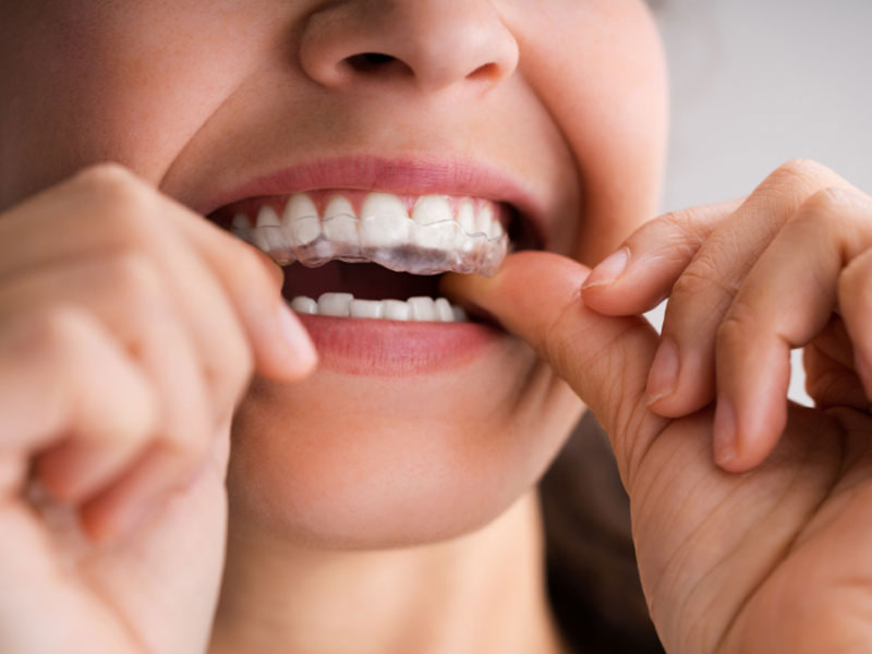 Featured image for “Why Invisalign Is Great for Adults”