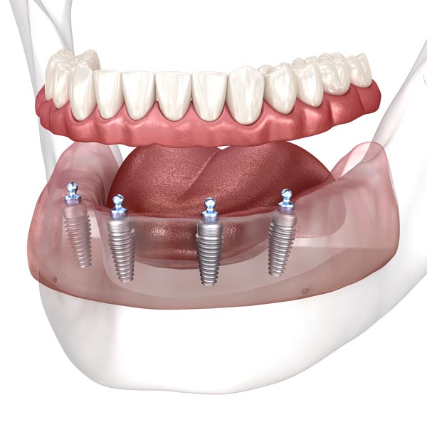 denture implants from sanford dental excellence