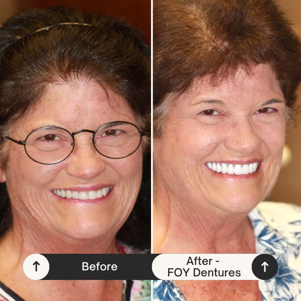 fountain of youth (FOY) dentures before and after results
