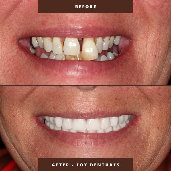 fountain of youth (FOY) dentures results by dr george mitrogogos