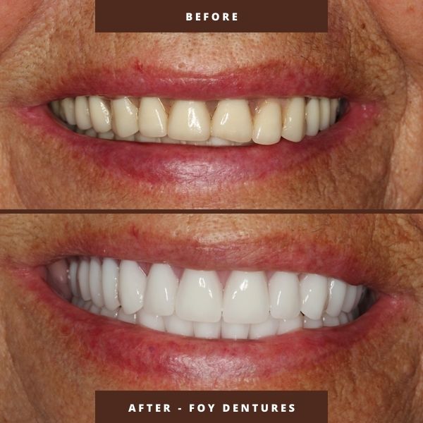 fountain of youth facelift dentures before and after results at sanford dental