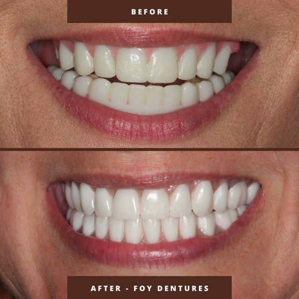 fountain of youth (FOY) dentures results by dr george mitrogogos
