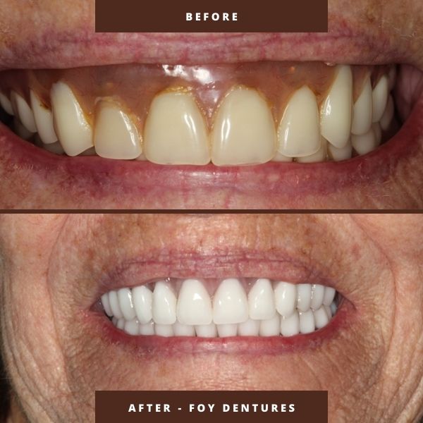 foy facelift dentures results by dr george mitrogogos