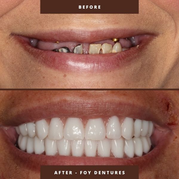 fountain of youth facelift dentures before and after by dr george mitrogogos
