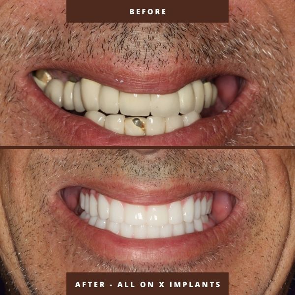 all on x full mouth dental implants with fixed bridges before and after orlando