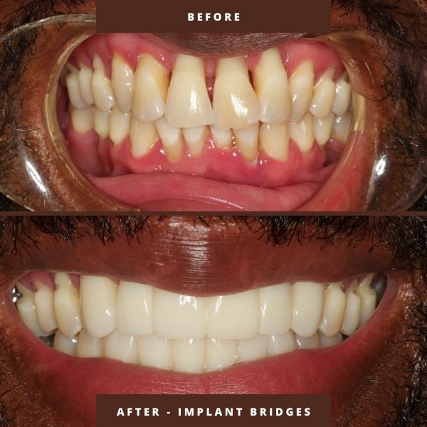 implant bridges before and after results orlando