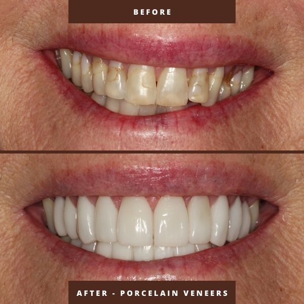 porcelain veneers before and after orlando