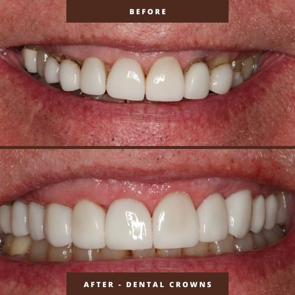 dental crowns before and after results orlando