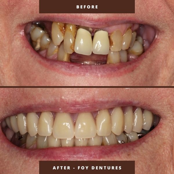 foy dentures orlando