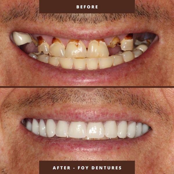 foy-dentures-fountain-of-youth-dentures-orlando fountain of youth (foy) dentures results by dr george mitrogogos
