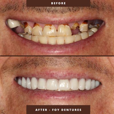 before and after foy dentures in orlando